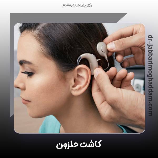 کاشت حلزون گوش