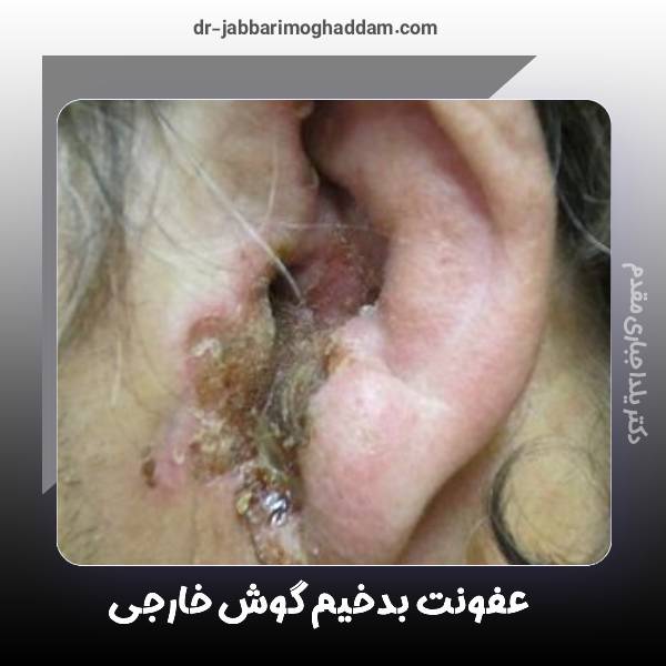 عفونت بدخیم گوش خارجی