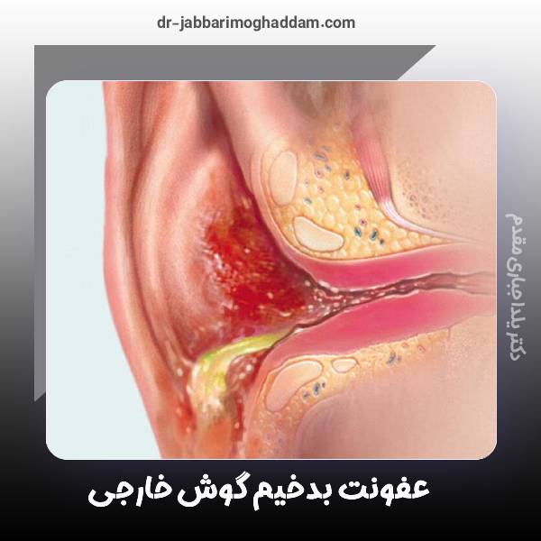 عفونت گوش خارجی