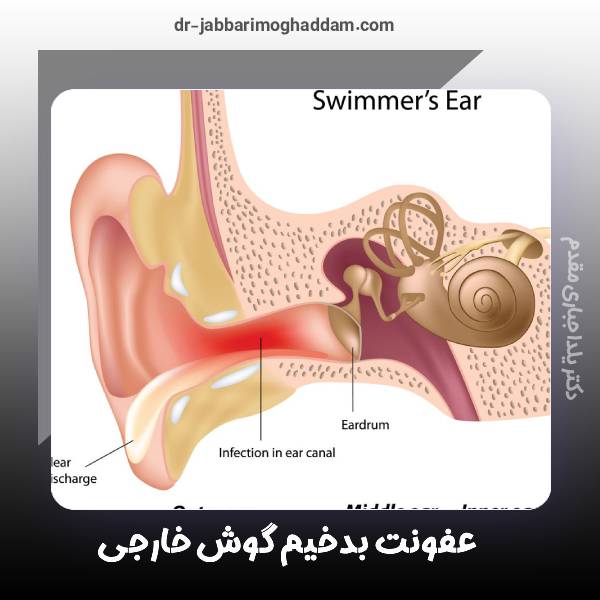 عفونت بدخیم گوش خارجی