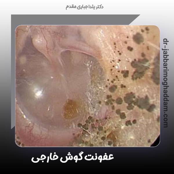 عکس عفونت قارچ در گوش خارجی