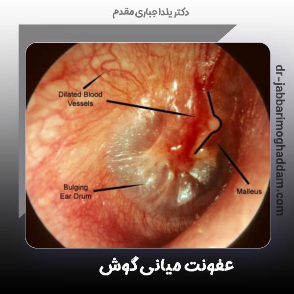 عفونت مزمن گوش میانی