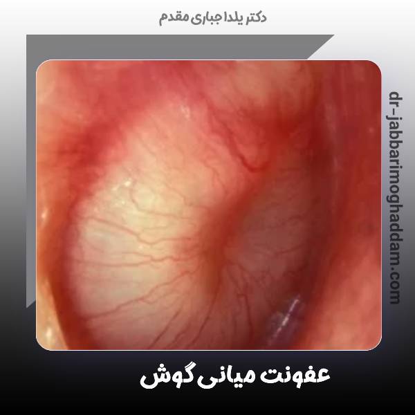 عفونت میانی گوش