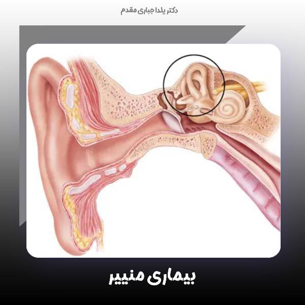 بیمای منییر