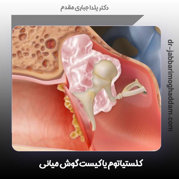 عفونت گوش میانی
