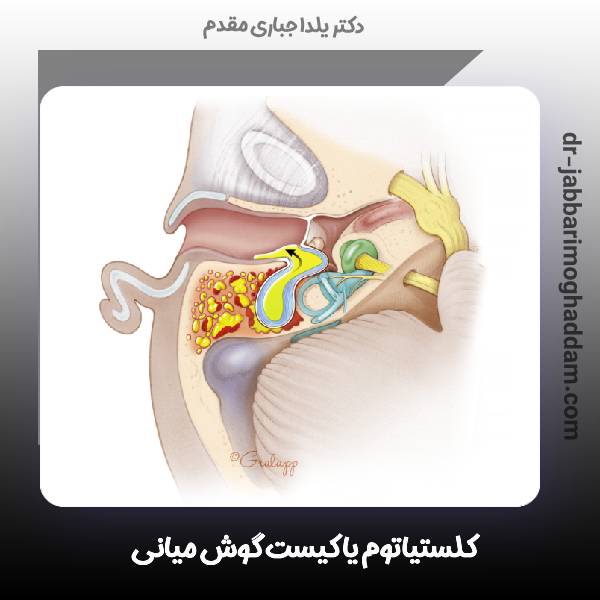 عکس کیست گوش میانی