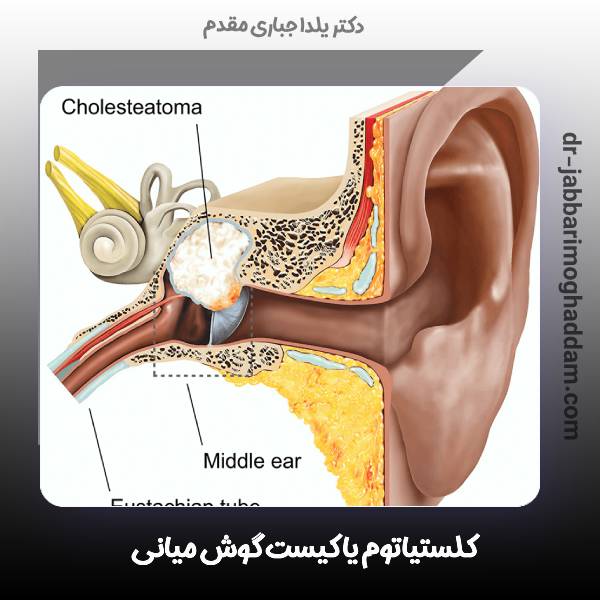 کلستیاتوم گوش میانی